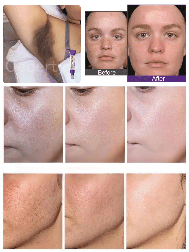 Highly effective whitening and spot-lightening cream